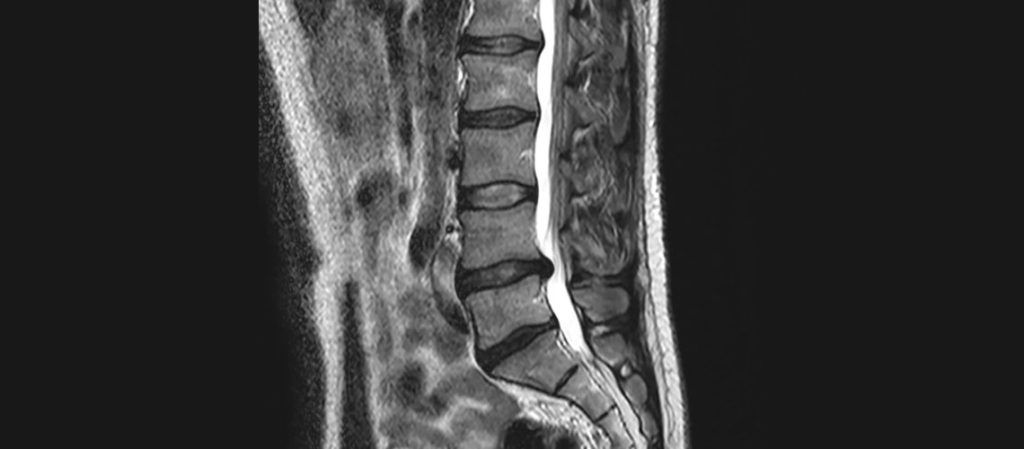 hernia columna